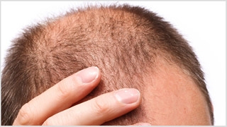 alopecia, trattamenti dermatologo cagliari guicciardi