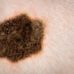 melanoma