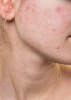 acne, trattamenti dermatologo cagliari guicciardi