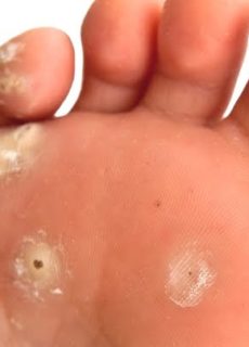 verruche trattamenti dermatologo cagliari guicciardi